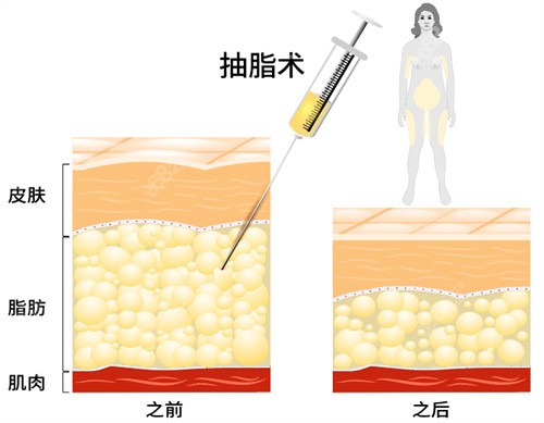 曹孟君富贵包抽脂