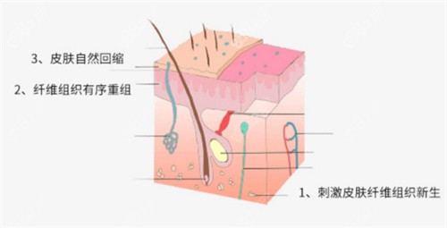 曹孟君富贵包抽脂