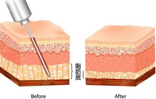 曹孟君富贵包抽脂