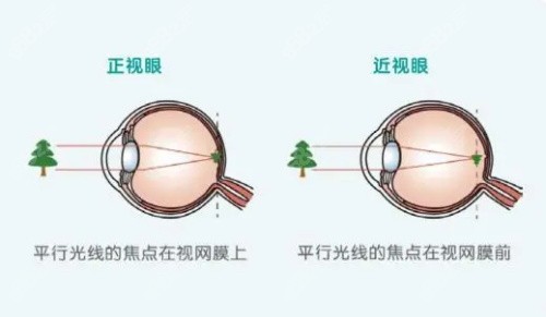 什么人做不了近视眼手术?公布不适合做近视手术的六类人群