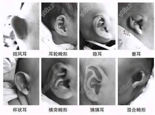 儿童耳朵畸形问题合集