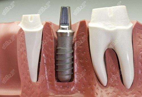 单颗种植牙图示