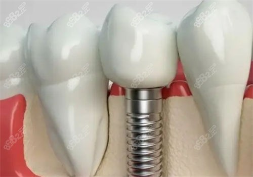 种植牙在牙槽中模拟展示.jpg
