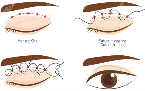 埋线双眼皮图.jpg