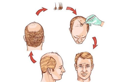植发步骤图