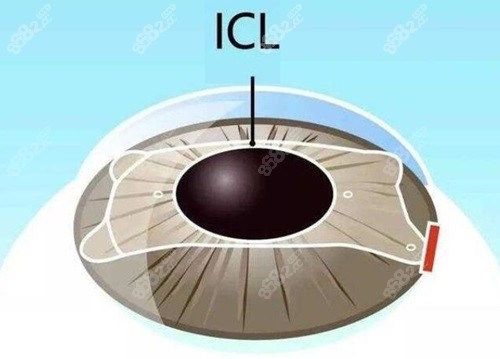 成都普瑞眼科ICL晶体植入近视矫正