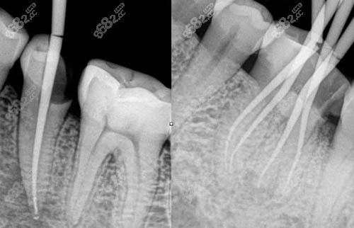 根管治疗ct照片