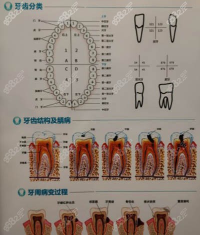 牙齿龋坏发展图