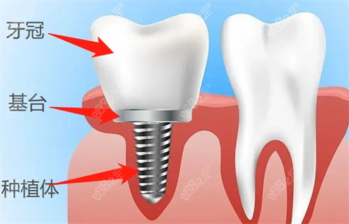 种植牙的组成部分图解