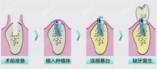 牙齿种植过程图解