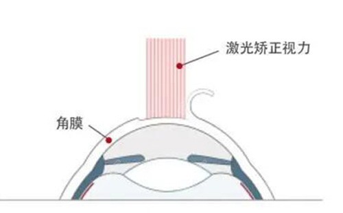 激光近视矫正改善.jpg