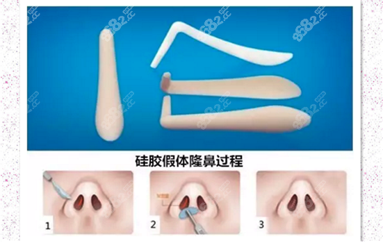 硅胶隆鼻手术优势