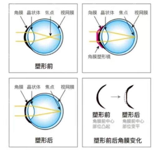 <!--<i data=20240705-sp></i>-->眼科医院角膜塑形镜价格