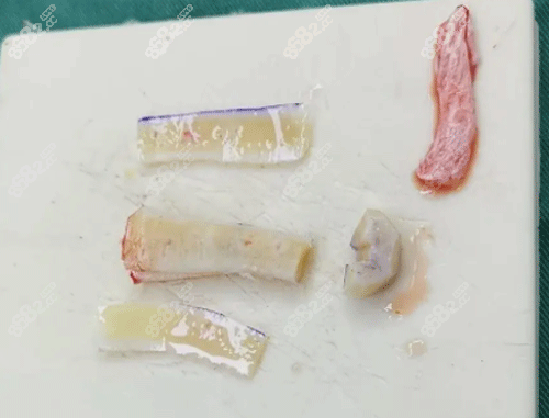 隆鼻肋骨材料