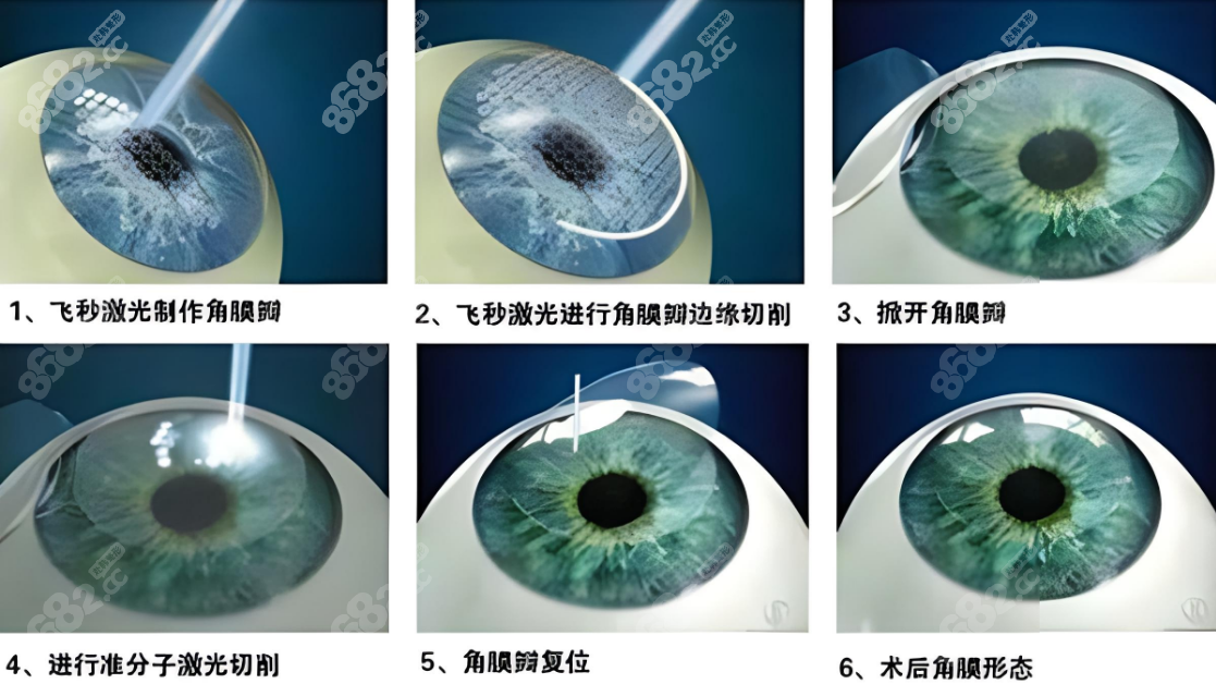 <!--<i data=20240705-sp></i>-->眼科医院飞秒激光近视手术费用www.8682.cc