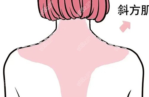 背部吸脂位置卡通示意图