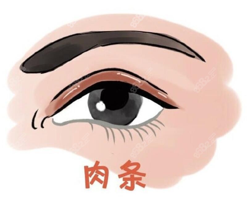 <!--<i data=20240705-sp></i>-->高难度修复双眼皮实例