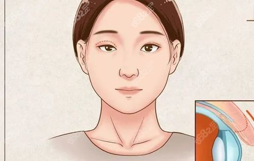为什么选择成都纯曦割双眼皮