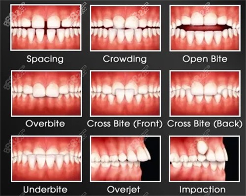 不同情况的畸形牙齿