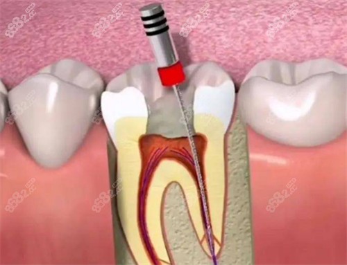 单颗牙齿根管治疗过程图片
