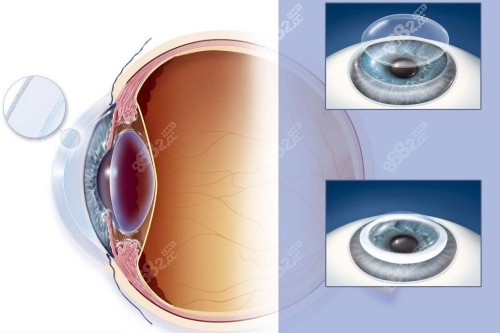 晶体置换手术示意图
