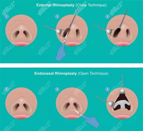 鼻整形过程图.jpg