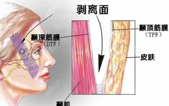 沈阳杏林整容医院小切口SMAS拉皮技术