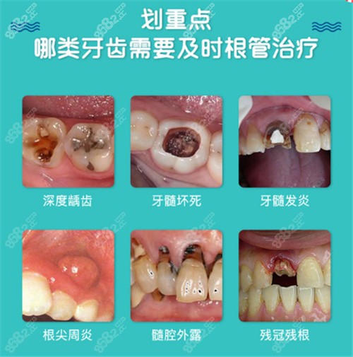 根管治疗适应症.jpg