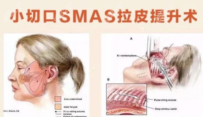 沈阳哪家做小切口smas拉皮好?