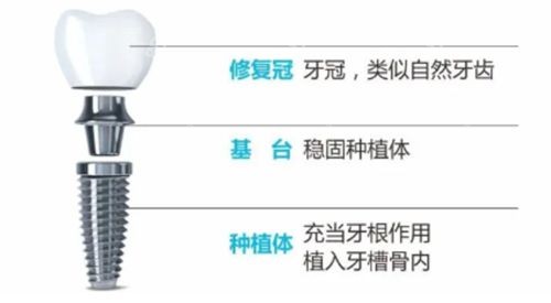 泰康拜博口腔醫(yī)院種植牙價目表 泰康拜博口腔醫(yī)院種植牙價目表