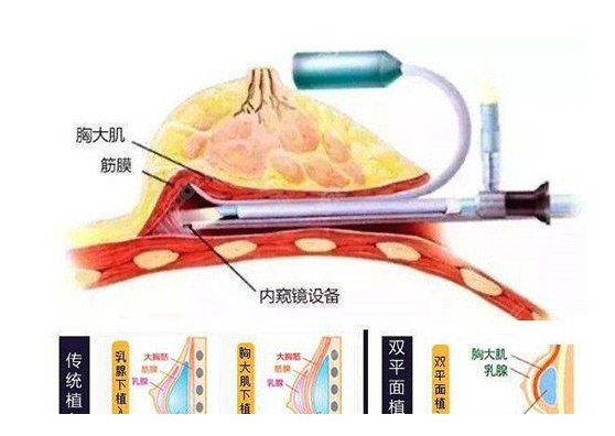 汪灏隆胸技术好