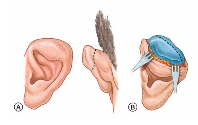 耳再造手术取自体软骨到底好不好