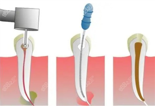 牙齿根管治疗过程图解