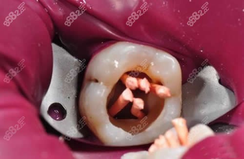 根管治療細(xì)節(jié)圖