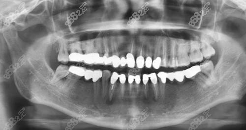 牙冠修復(fù)ct照片