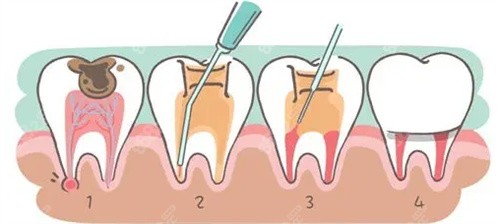 牙周治疗卡通过程图