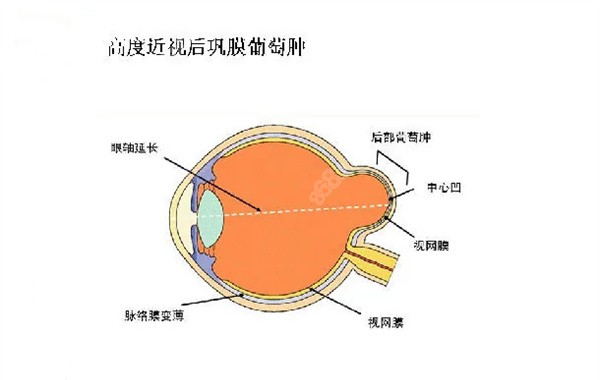 后巩膜加固术