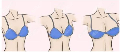 乳房下垂悬吊提升双环和棒棒糖手术有哪些区别？