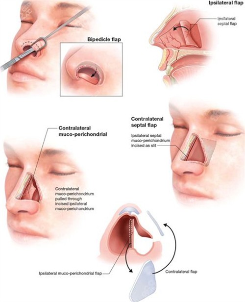 鼻再造修复过程
