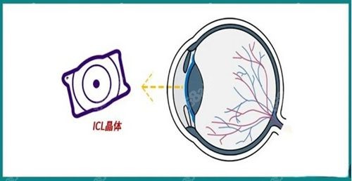 <!--<i data=20240705-sp></i>-->院长眼科做得好的是icl晶体植入手术