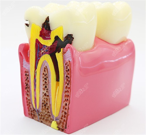 牙齿龋坏剖面图.jpg