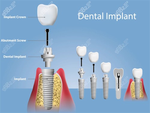 种植牙组成部分图解