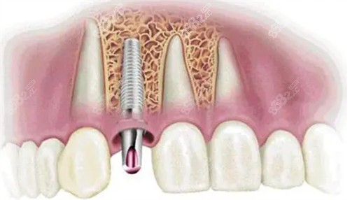 牙齿种植植入植体过程图解