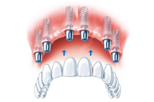 全口种植牙示意图