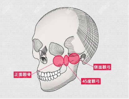 李志海颧骨修复手术做得好