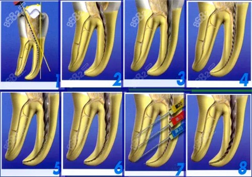 根管治疗步骤图
