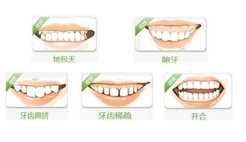 五种需要正畸的牙齿情况图解
