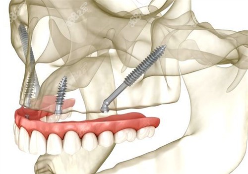 all-on-4牙齿种植技术图解