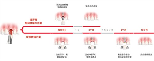 种植牙过程图解