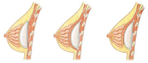 假体隆胸植入不同层次示意图